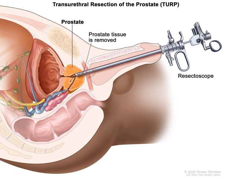 مقایسه مگنتو هولپ و TURP