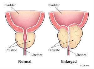 مقایسه مگنتو هولپ و TURP