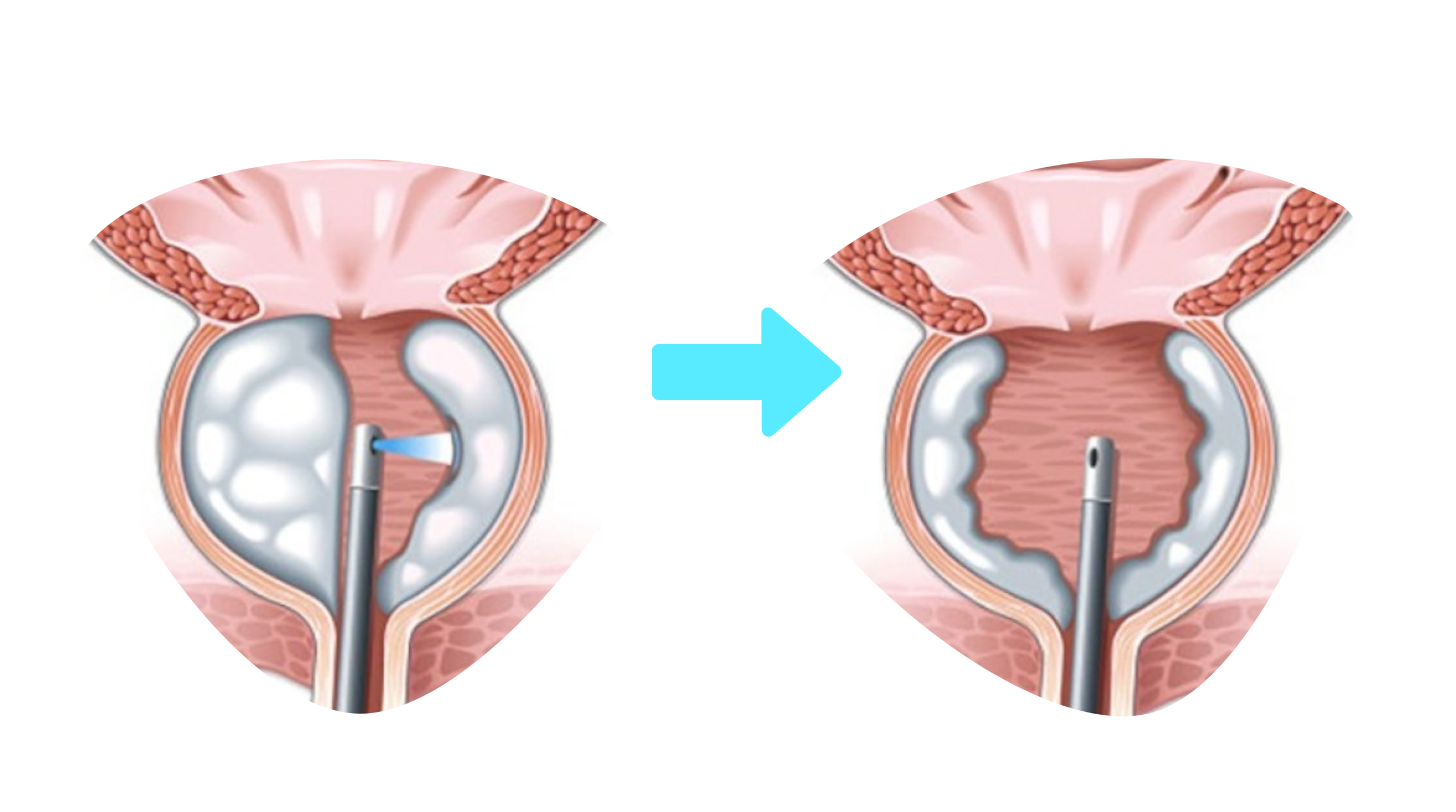 جراحی پروستات در سنین بالا