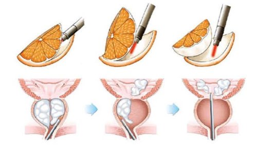 لیزر هولمیوم مگنتو